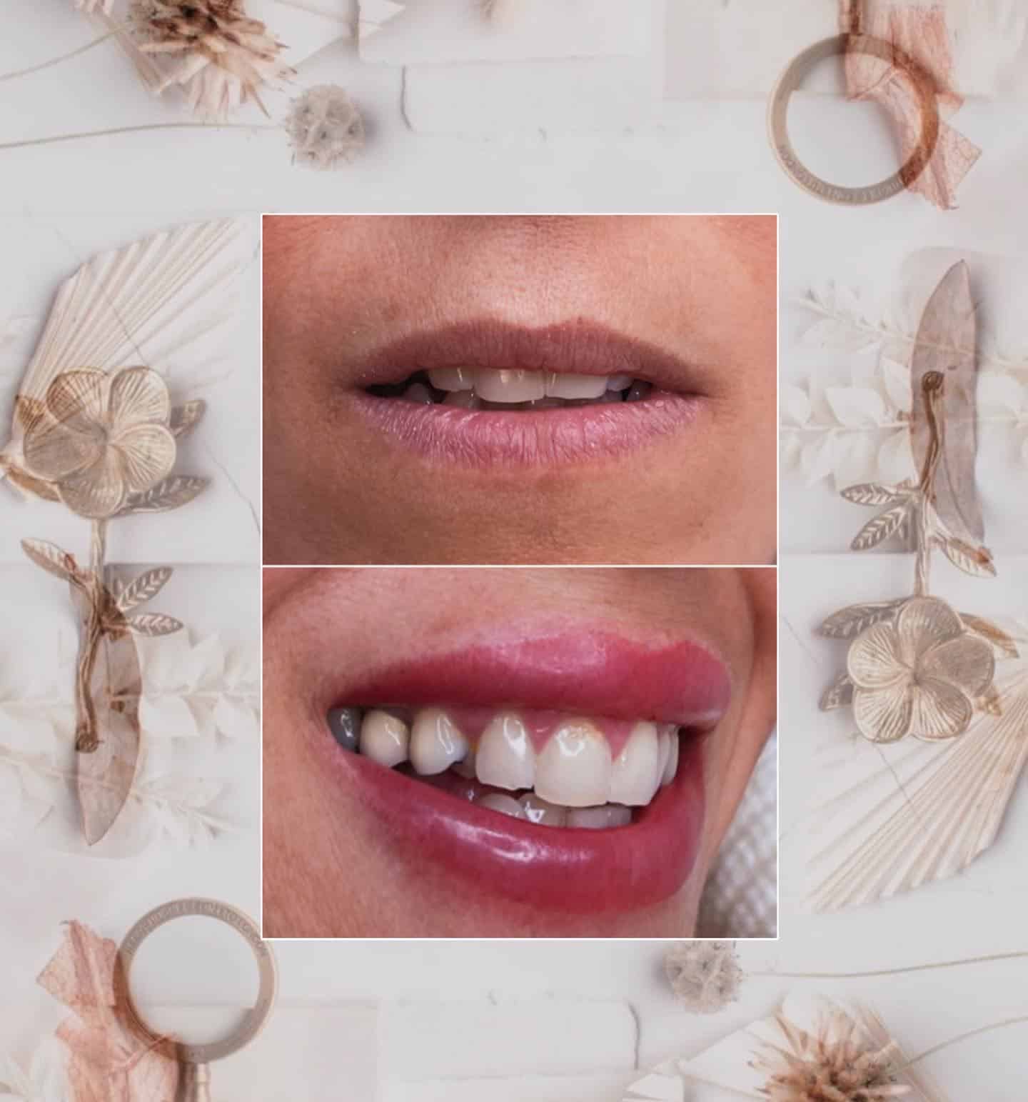 לפני ואחרי — הלנייז